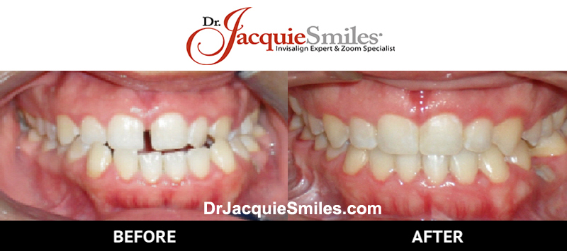 before-after-patient-dr-jacquie-0002