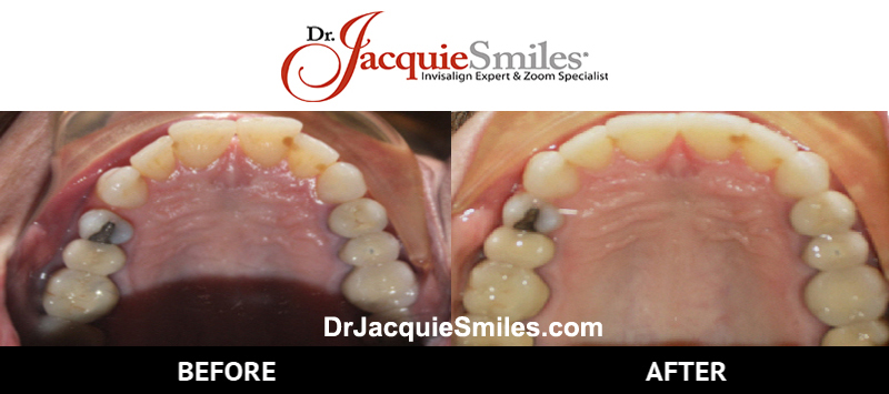 before-after-patient-dr-jacquie-3
