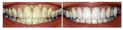 tooth whitening before and after patients in NYC