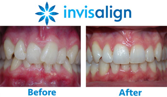 Dr. Jacquie is an Invisalign dental specialist in Woodbury, Long Island, NY.