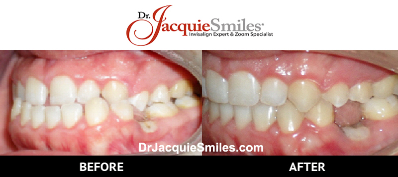before-after-patient-dr-jacquie-00002