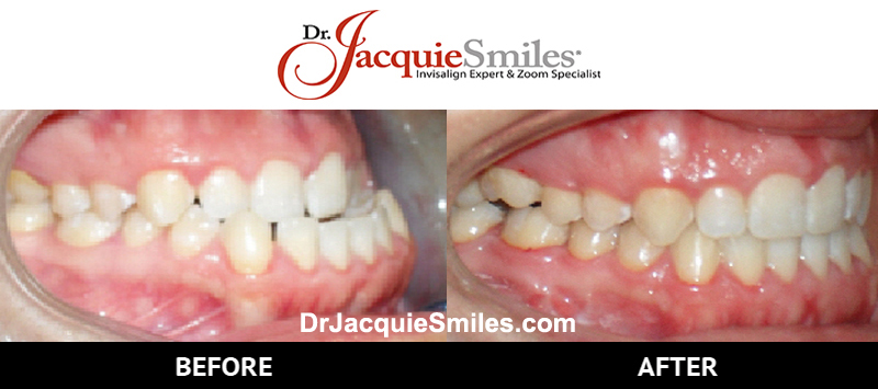 before-after-patient-dr-jacquie-002