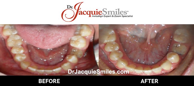 before-after-patient-dr-jacquie-02