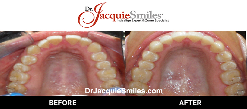 before-after-patient-dr-jacquie-2