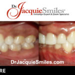 before-after-patient-dr-jacquie-000011
