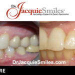 before-after-patient-dr-jacquie-000031