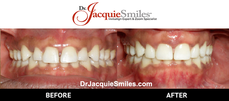 before-after-patient-dr-jacquie-00011