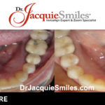 before-after-patient-dr-jacquie-031