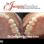 before-after-patient-dr-jacquie-1-2
