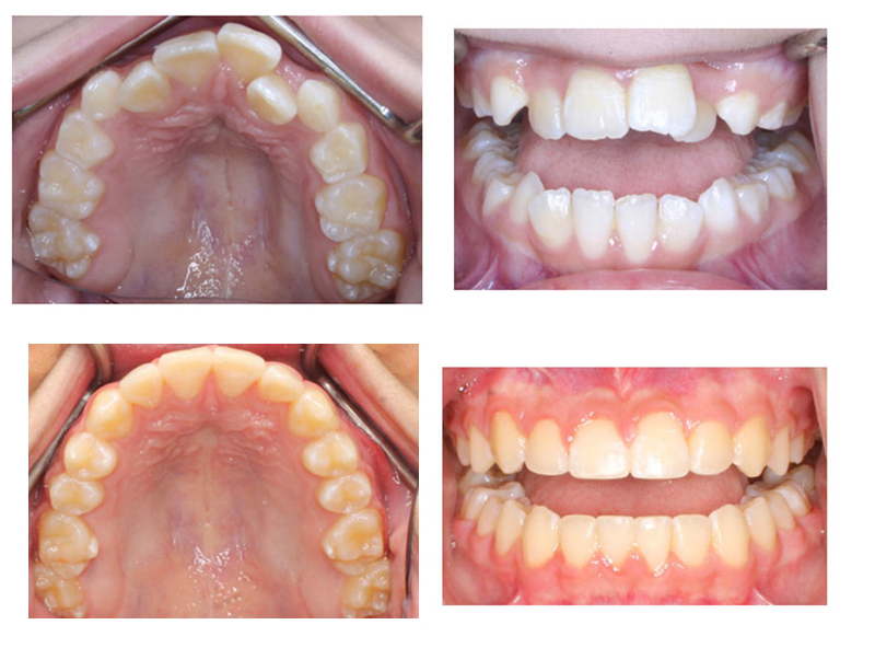Fast Orthodontic Treatment Results Fast Orthodontic Treatment Results