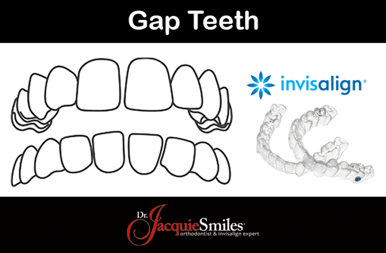 Invisalign Clear Braces Treatment for gap teeth in NYCDr. Jacquie