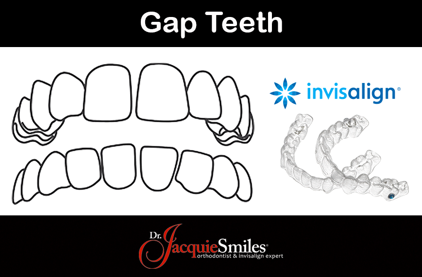 gapped tooth tooth gap invisalign