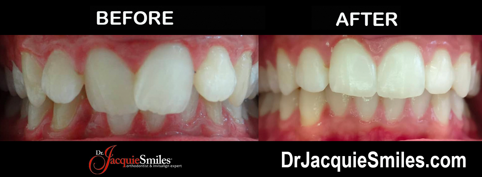 Invisalign Before and After Photos of NYC PatientsDr. Jacquie