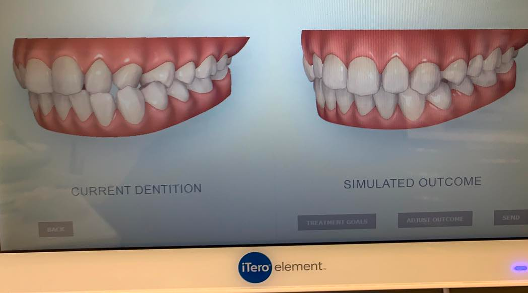 Simulated Orthodontics in NYC Preview your smileDr. Jacquie