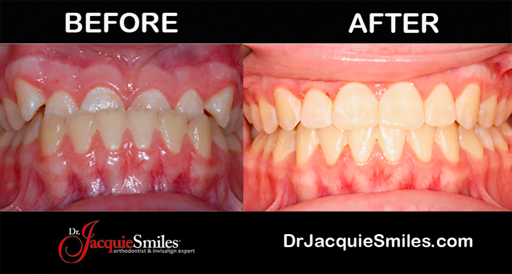 underbite teeth Invisalign clear braces before after NYC