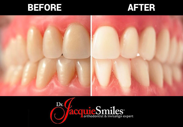 Pros and Cons of In office Teeth Whitening in Monroe NYDr Jacquie