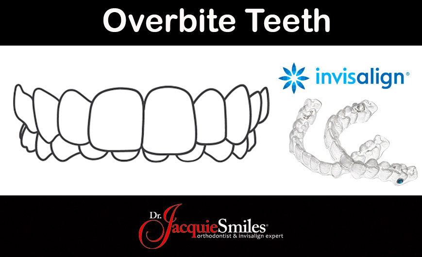 Invisalign Clear Braces Treatment for an Overbite in NYCDr. Jacquie
