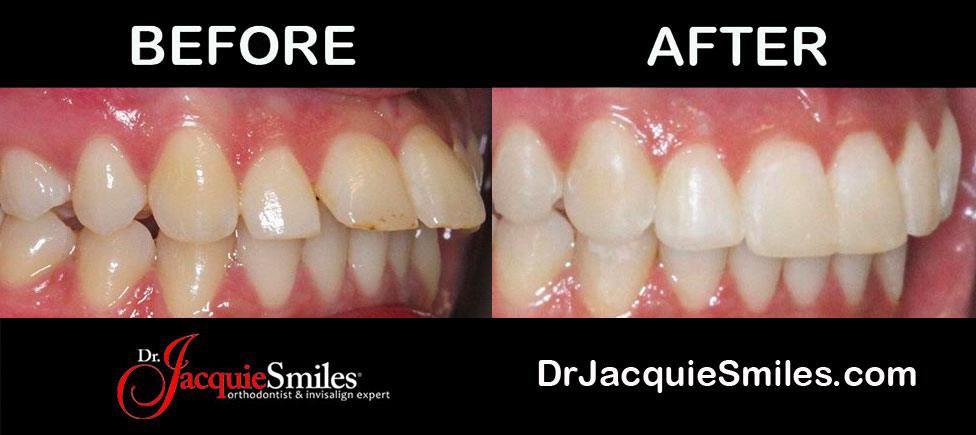 overbite teeth Invisalign clear braces before after NYC