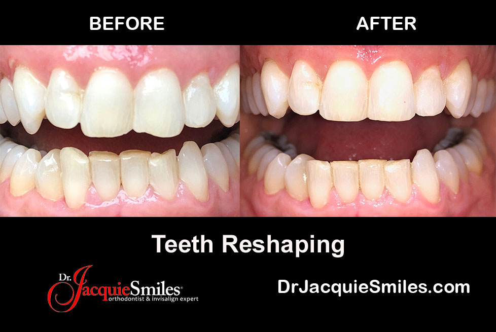 Invisalign Before and After Photos of NYC PatientsDr. Jacquie