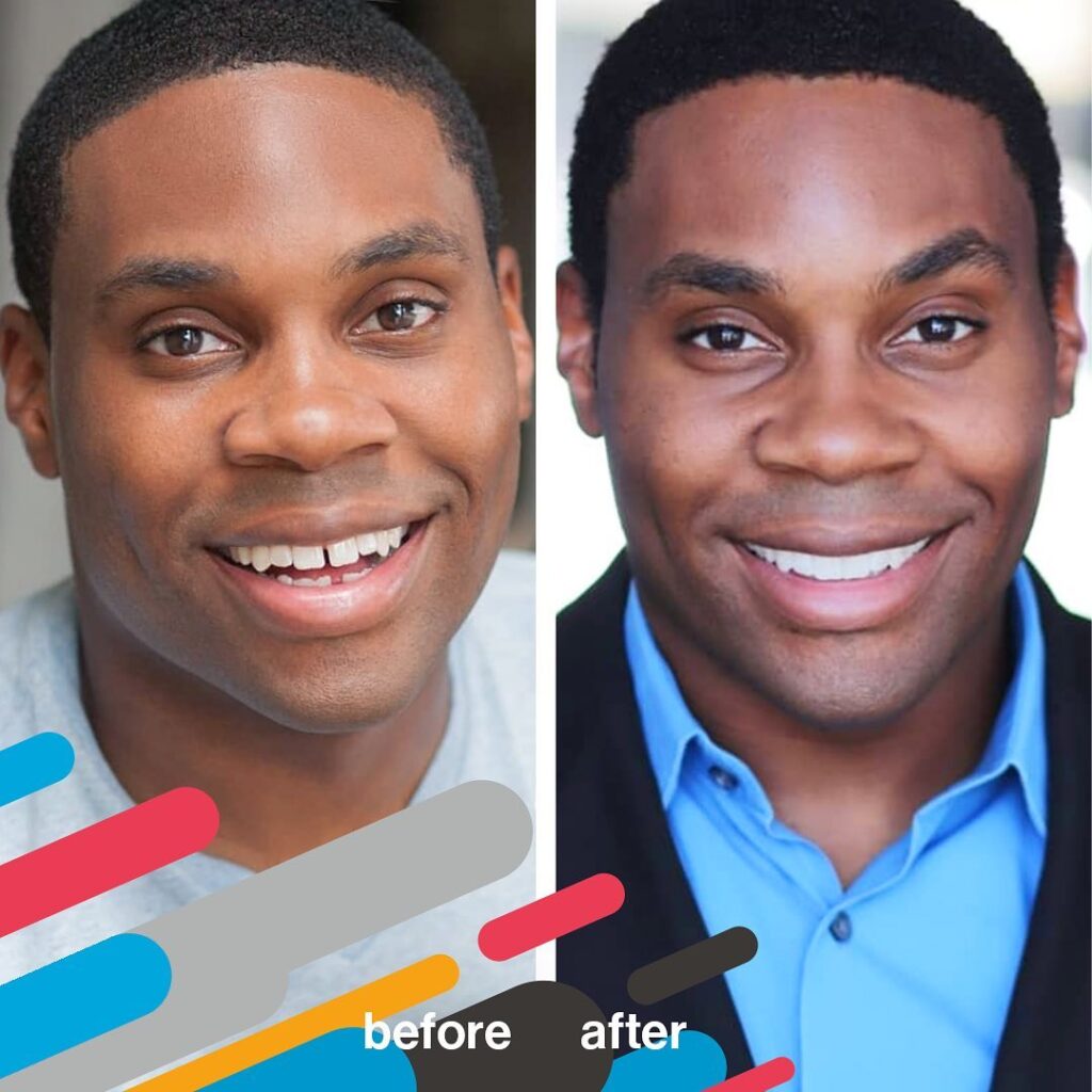 Invisalign before and after photo