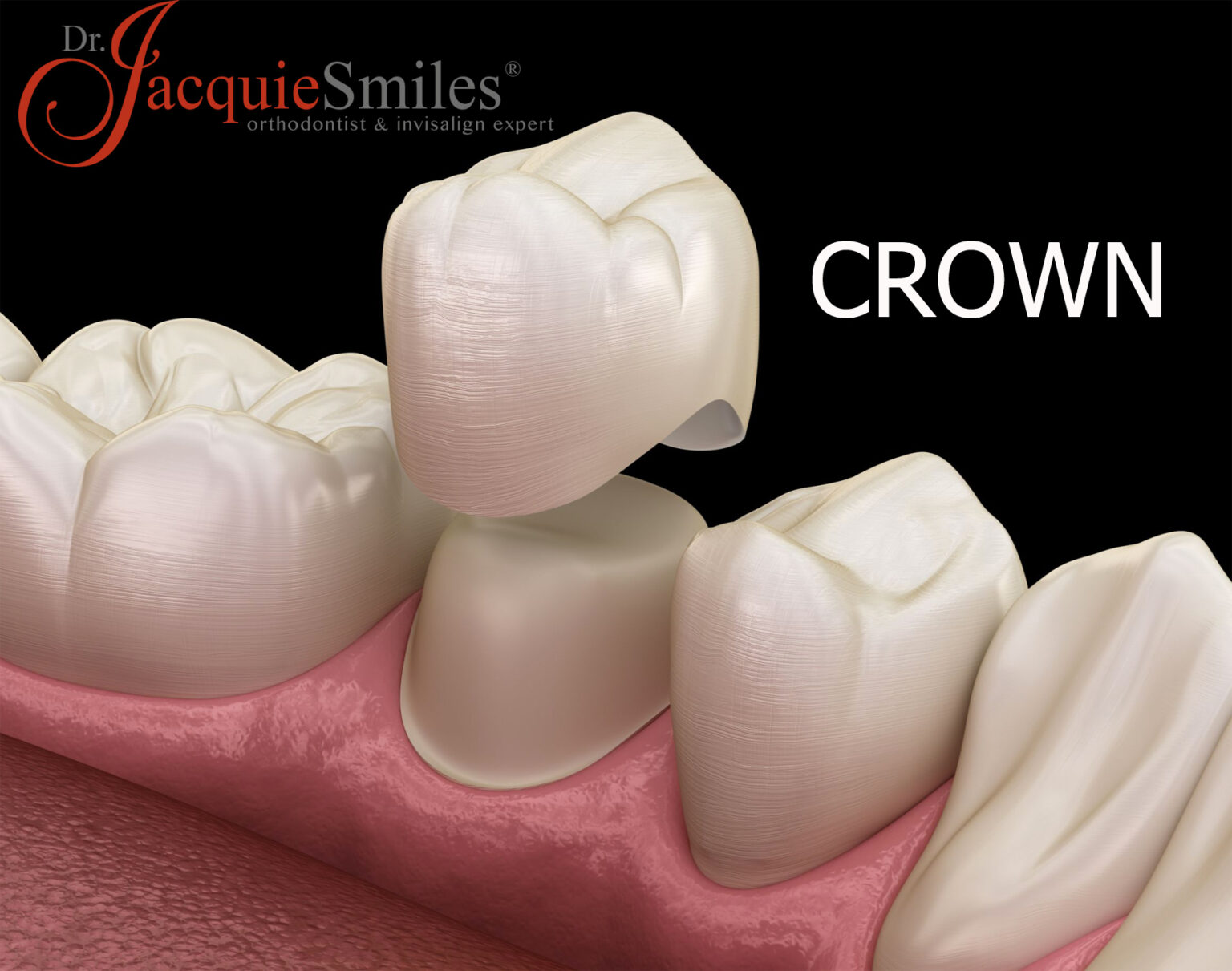 Benefits of Dental CrownsDr. Jacquie