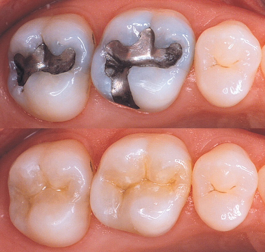 Dental Filling - How Long Does it Take to Fill a Cavity